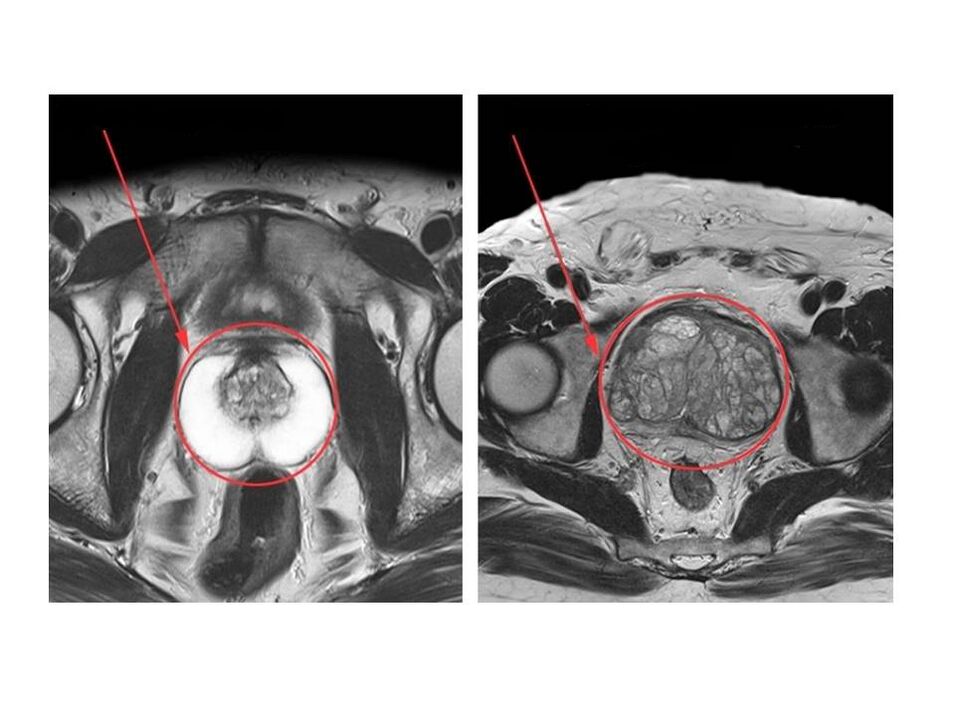 Σύγκριση ενός υγιούς (αριστερά) και ενός φλεγμονώδους (δεξιά) προστάτη σε εικόνες μαγνητικής τομογραφίας